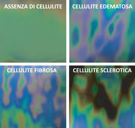Stadi di cellulite